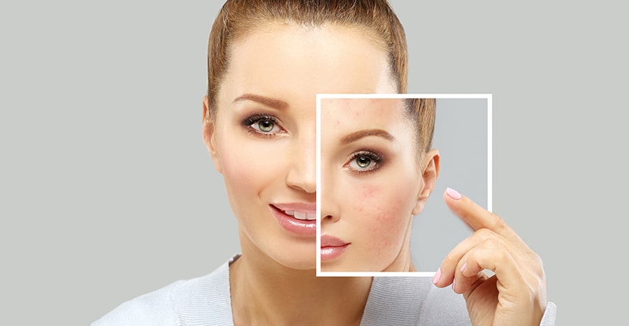 , Acne Treatments
