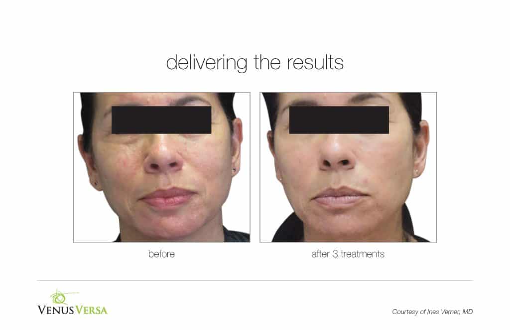 Skin Resurfacing, Skin Resurfacing / Wrinkle Reduction